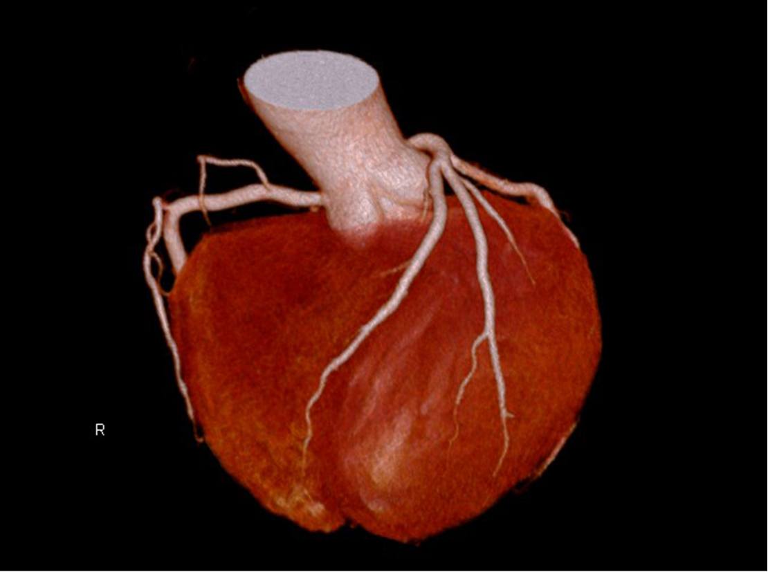 冠動脈３D